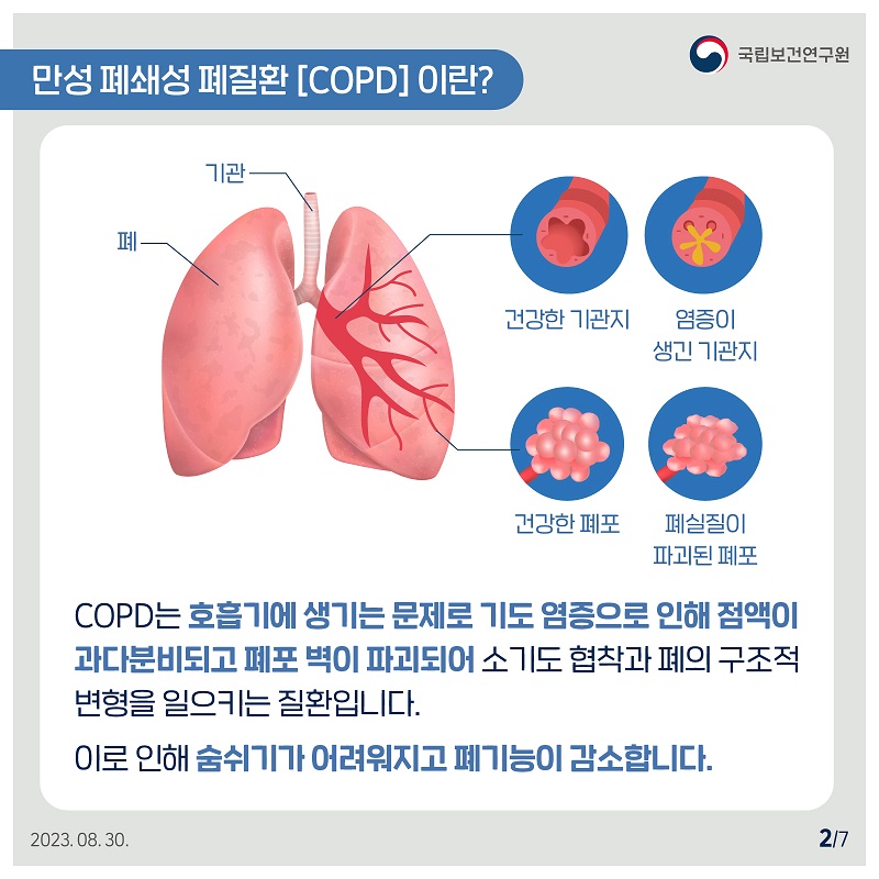 국립보건연구원 /  만성폐쇄성폐질환 [COPD] 이란? 폐 기관 건강한 기관지, 염증이 생긴 기관지, 건강한 폐포, 폐실질이 파괴된 폐포 COPD는 호흡기에 생기는 문제로 기도 염증으로 인해 점액이 과다분비되고 폐포 벽이 파괴되어 소기도협착과 폐의 구조적 변형을 일으키는 질환입니다. 이로 인해 숨쉬기가 어려워지고 폐기능이 감소합니다. 2023.08.30. 2/7